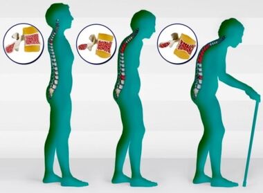 Osteoporosi